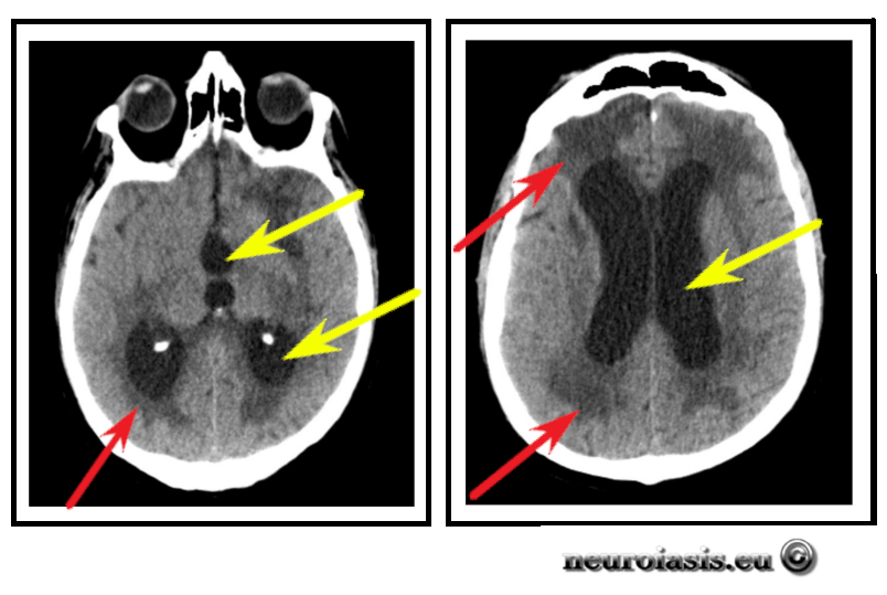 ΥΔΡΟΚΕΦΑΛΟΣΑξονική Τομογραφία Εγκεφάλου η οποία αναδεικνύει την διάταση των κοιλιών, το υποεπενδυματικό οίδημα με περιορισμό των υπαραχνοειδών χώρων του εγκεφάλου. 