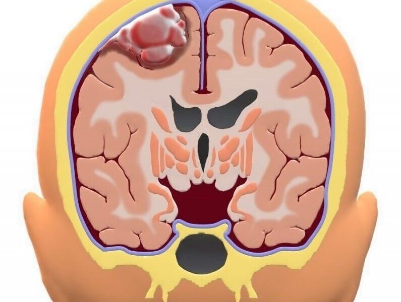 Όγκος Εγκεφάλου