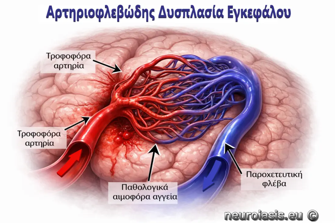 Αρτηριοφλεβώδης δυσπλασία εγκεφάλου με απεικόνιση τροφοφόρας αρτηρίας, παθολογικών αγγείων (nidus) και παροχετευτικής φλέβας