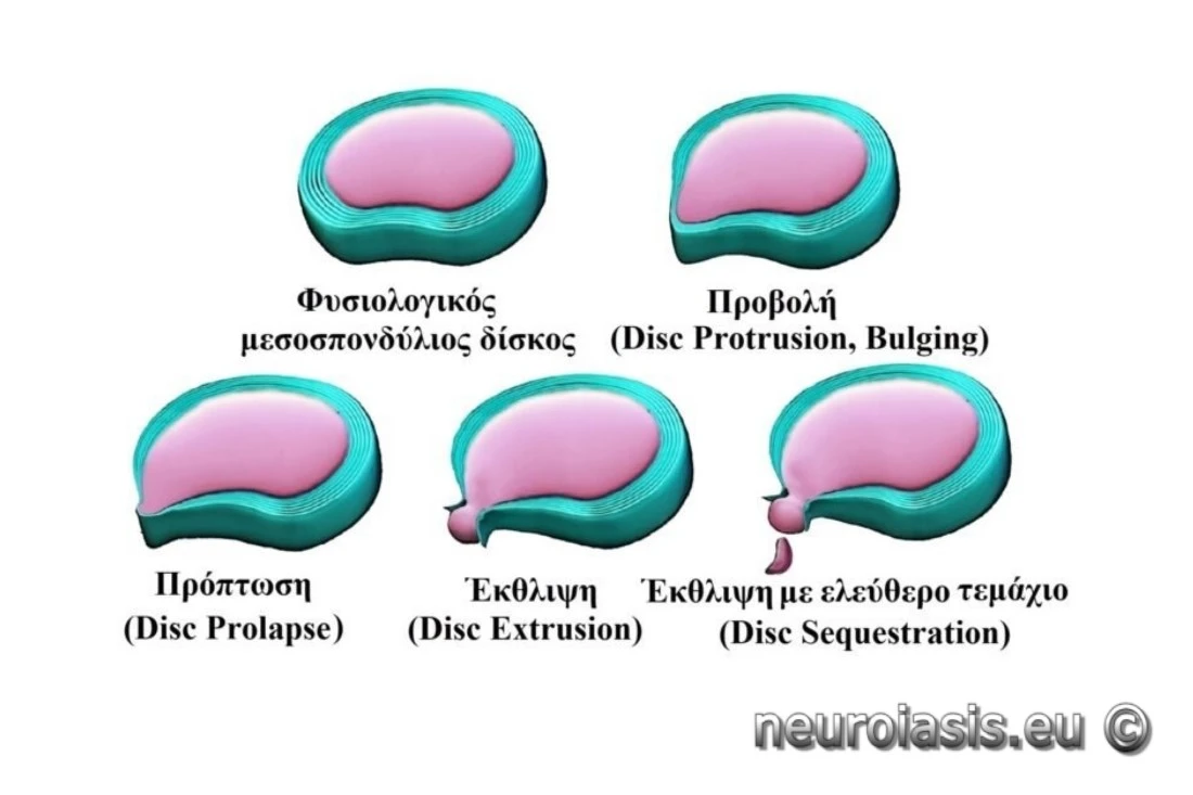Τα στάδια δημιουργίας δισκοκήλης, εκφυλιστική δισκοπάθεια