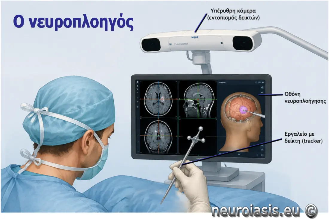 Νευροπλοήγηση στη χειρουργική αντιμετώπιση Μηνιγγιώματος Εγκεφάλου